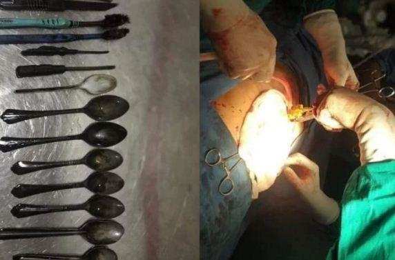 हैरतअंगेज | मरीज के पेट से निकले 8 चम्मचें, 2 टूथब्रश और 2 स्क्रूड्राइवर