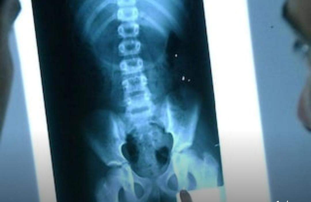 महिला के प्राइवेट पार्ट में मिला ये सामान, X-Ray देख उड़े डॉक्टरों के होश